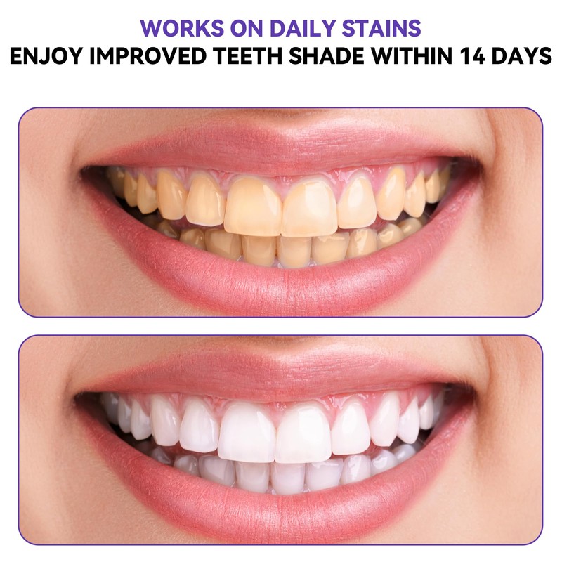 28 Strips | Purple Teeth Whitening Strips | Professional Teeth